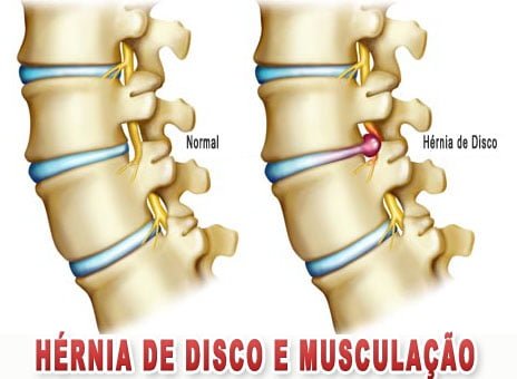 Hérnia de Disco e Musculação