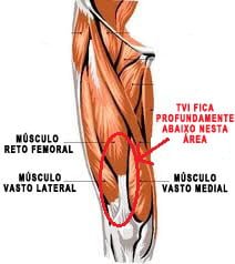 novo músculo tvi quadríceps